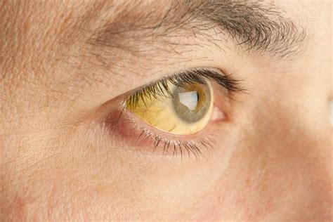 symptoms  jaundice  viral hepatitis