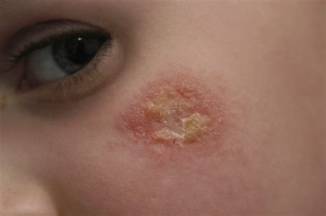 Bad Eczema Pictures