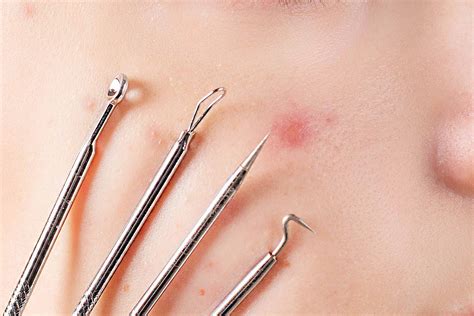 Unbelievable Blackhead Removal 2024: The Science Behind Clear Skin! Image 15