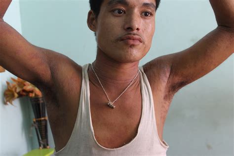Photodermatitis patient from Nepal cured in 1 Month with homeopathy