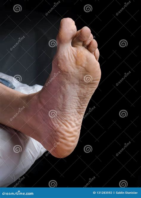 Close Up of Calluses. Painful Corn on Foot. Treatment of Corns on the