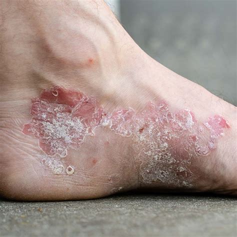Schuppenflechte (Psoriasis) – Symptome, Ursachen & Tipps