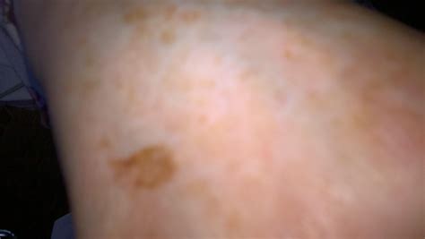 Acanthosis Nigricans in Pre-diabetic states | British Journal of ...