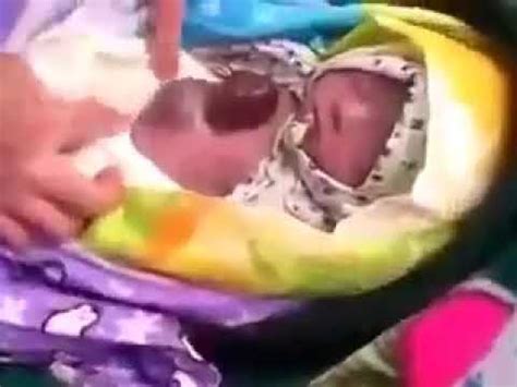 Срочно нужен ваш помощ Мухаммаду для диагноз Эктопия Сердца просем вас ...