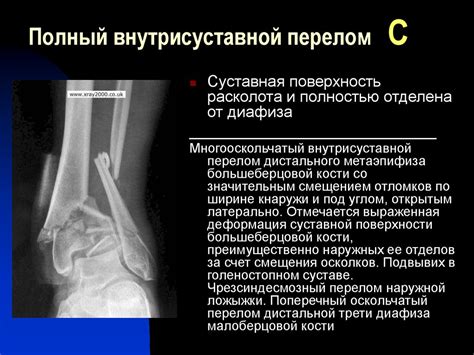 Переломы плечевой кости - презентация онлайн