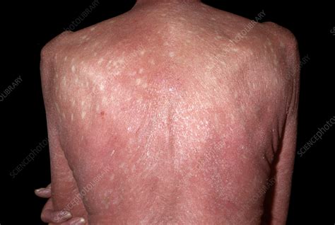 Pityriasis rubra pilaris - Stock Image - C059/5138 - Science Photo Library