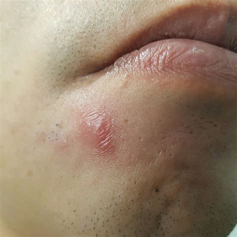 Does anyone know what this is? Red lump – Acne – Acne.org Forum