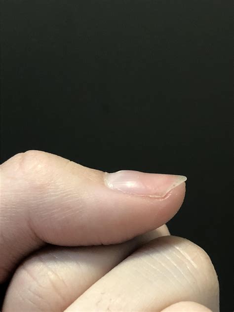 Why Is There A Lump On My Fingernail at James Jennings blog