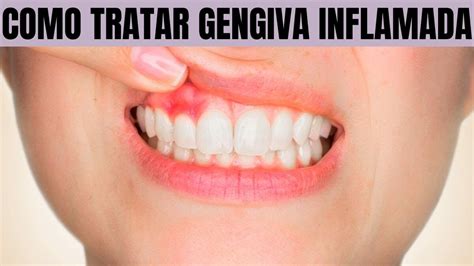 Como Desinchar A Gengiva