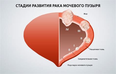 Прогнозы на жизнь при раке мочевого пузыря