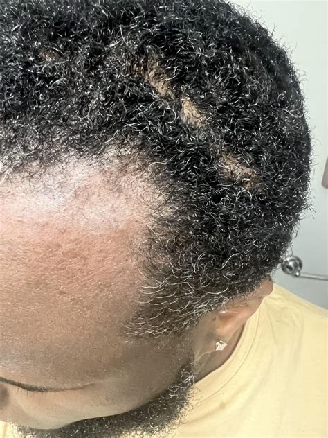 Really dry scaly scalp : r/DermatologyQuestions