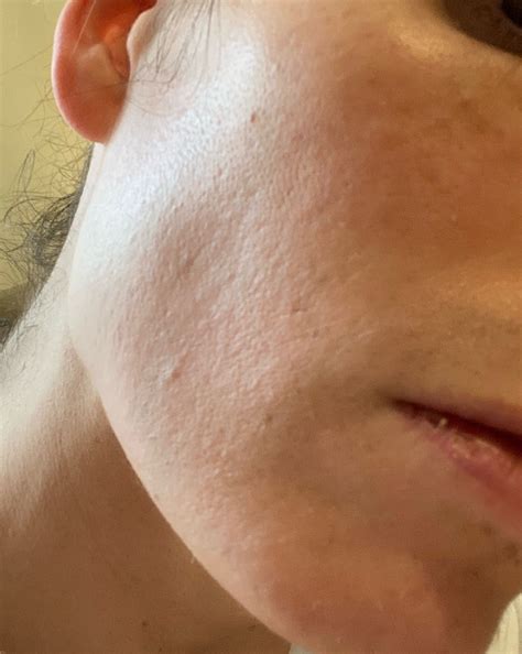 BAD Electrolysis Scarring Advice – Please Help! – Acne Scars – Acne.org