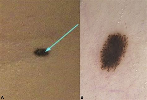 Pediatric pigmented Spitz nevus: A natural course toward involution