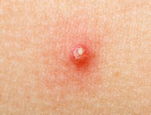 Difference Between Pustules and Papules | Difference Between