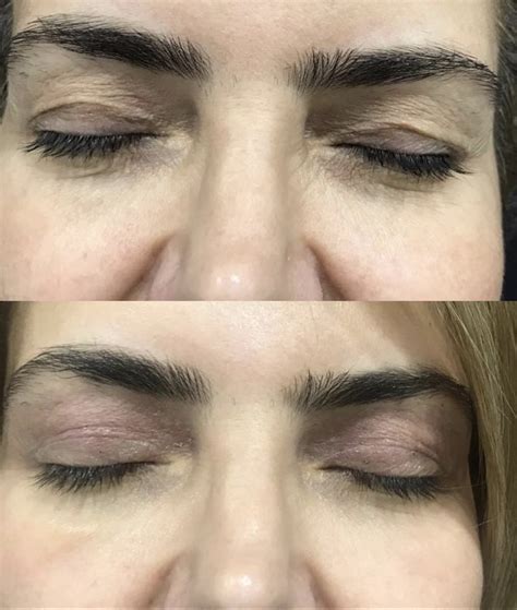 Неоперативна блефаропластика | Derma Life