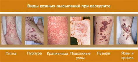 Васкулит – причины, симптомы и лечение васкулита