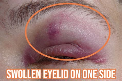 Unraveling Causes: Why is Only One Eyelid Swollen?