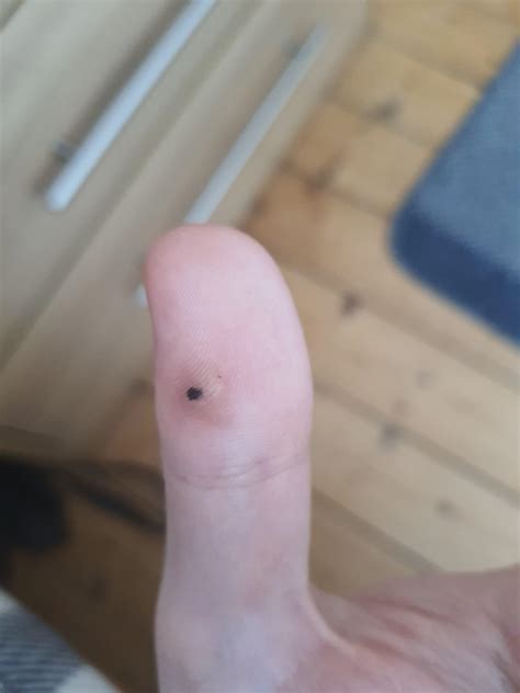Is this a wart? I've had it as long as I can remember (23m), and tried