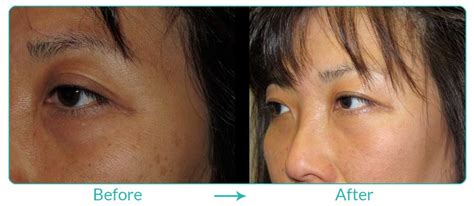 Asian Blepharoplasty Gallery LA | Eyesthetica
