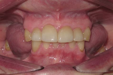 Removable Partial Dentures Smile Gallery - Raber Dental, Kidron Dentist