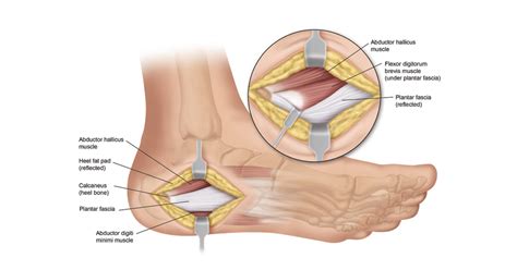 Plantar Fasciitis Surgery and Recovery | Heel That Pain