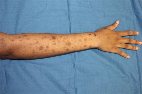 Post-Inflammatory Hyperpigmentation – Digital Dermatology Atlas