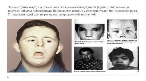 Особенности ранней логопедической помощи детям с синдромом Дауна ...