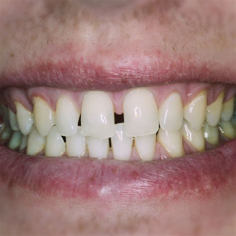Diastema | Why Am I Getting a Gap in My Front Teeth? // 3Dental
