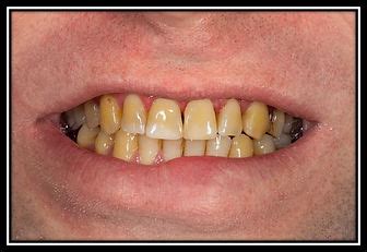 stained teeth homeland ave dental