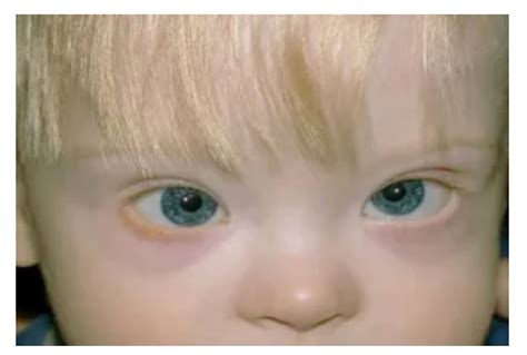 syndrome ocular manifestation  children vision science academy
