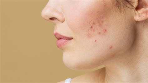 How To Tell The Difference Between Hormonal And Bacterial Acne
