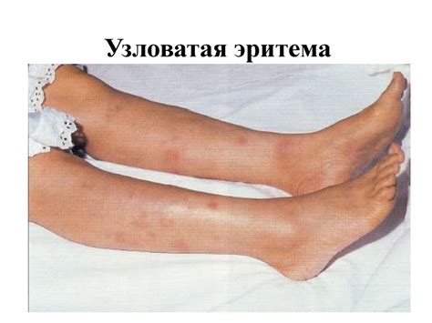 Острая ревматическая лихорадка. Миокардиты - презентация онлайн