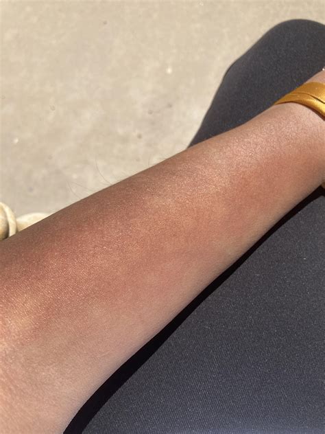 Yesterday, I had my first Lupus Rash from the Sun. I wasn’t even 5