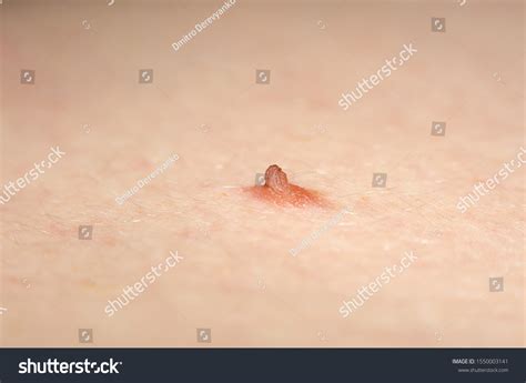 Papilloma Nevus Mole On Human Skin Stock Photo 1550003141 | Shutterstock