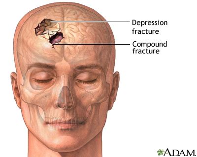 Compound Skull Fracture