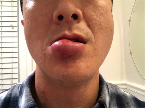Staph Infection On Lips