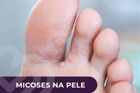 Micose Que Anda Na Pele - Micoses na Pele | Tratamento | Luciana Villas Boas