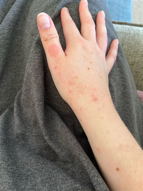Does this look like scabies? : r/scabies