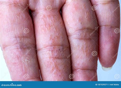Atopic Dermatitis Palms