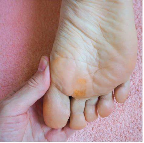 5 Best Ways How to Remove a Callus Safely | Balance Foot