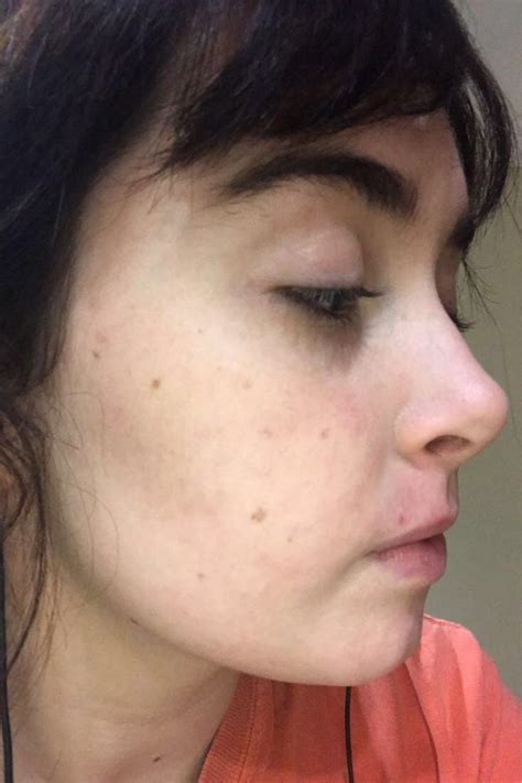 experience  accutane accutane acne topical treatments