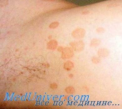 Кожный лишай как избавиться от него