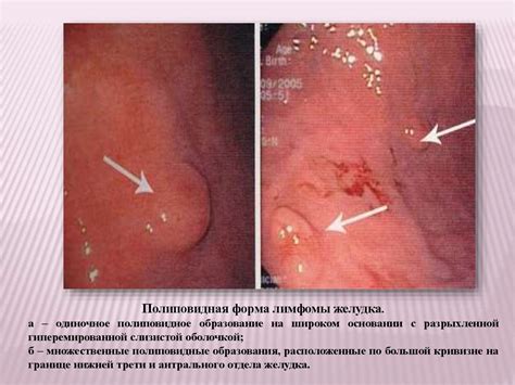 Рак желудка. Клиника, диагностика, лечение - online presentation