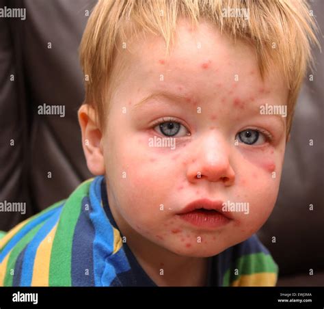 baby powder chicken pox  susan taube blog