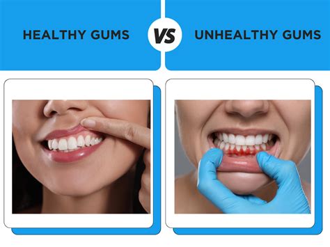 healthy gums  kwc dental