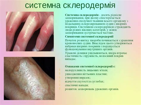 Презентація з дерматовенерології на тему: " Системні захворювання ...
