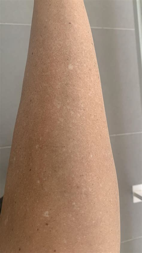 Idiopathic Guttate Hypomelanosis