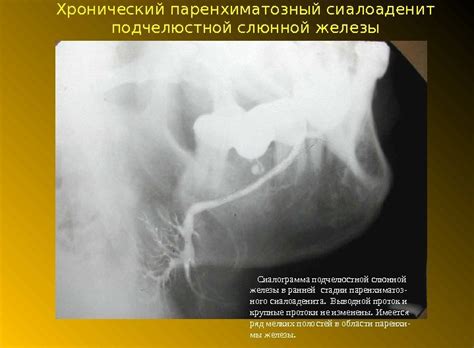 Воспаление слюнных желез (околоушной, подчелюстной и подъязычной ...