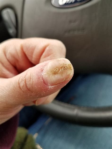 I was told this is median nail dystrophy. Is there anything I can do to