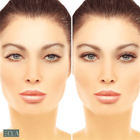 Upper VS. Lower Blepharoplasty in Dubai: Which Suits You? - Gulfinside
